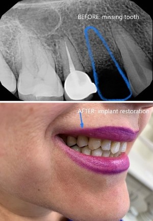 Before and After Implant Restoration